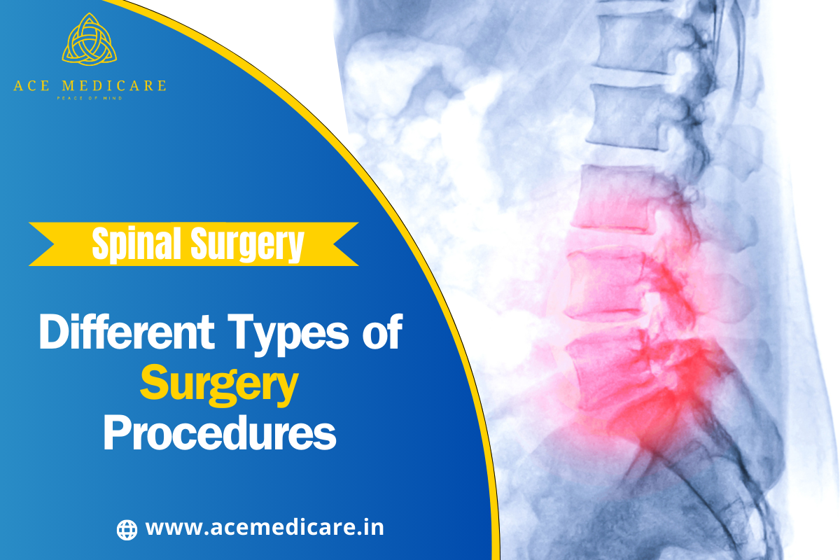 Understanding the Different Types of Spinal Surgery Procedures